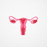 Aborder naturellement les fibromes utérins